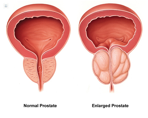 A diagram showing the difference between an enlarged prostate and a normal prostate