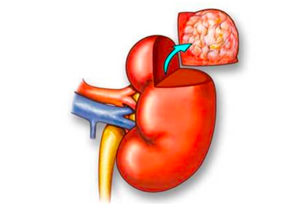 A diagram of a kidney where an infected region is cut out