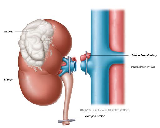 A diagram illustrating a radical nephrectomy