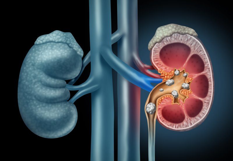 A diagram of two kidneys, one with kidney stones